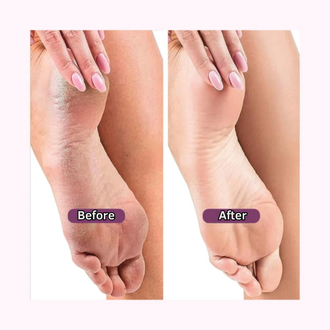 GloBare™ – Electric Callus Remover