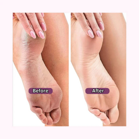 GloBare™ – Electric Callus Remover